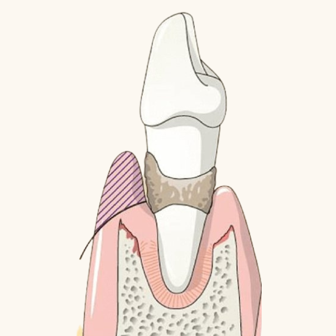 Periodontal Pockets